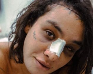 Linn da Quebrada mostra resultado após cirurgia de afirmação de gênero