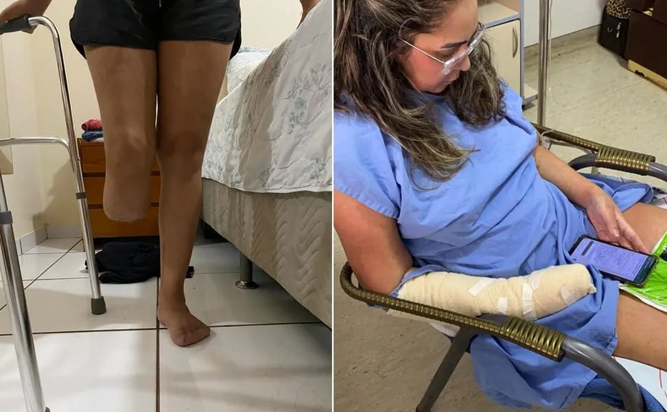 Consequências de lipoaspiração causaram amputação de membro inferior e dedos de mulher em Goiânia