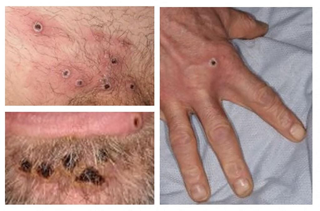 As lesões na pele parecem as da catapora ou da sífilis até formarem uma crosta, que depois cai