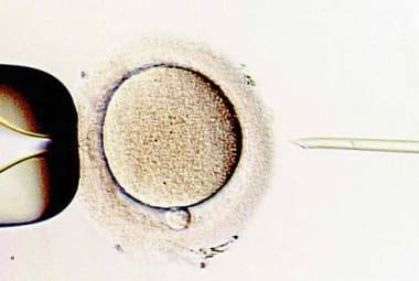 Fertilização in vitro pode se tornar mais eficaz