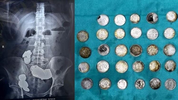 Homem teve moedas e ímãs retiradas do estômago e intestino delgado na Índia