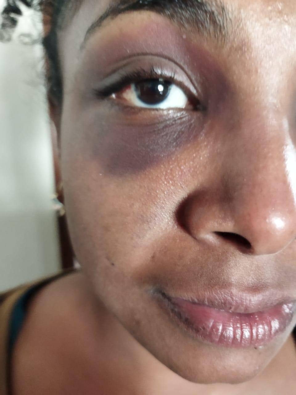 Mulher teve hematomas pelo corpo e na região dos olhos.