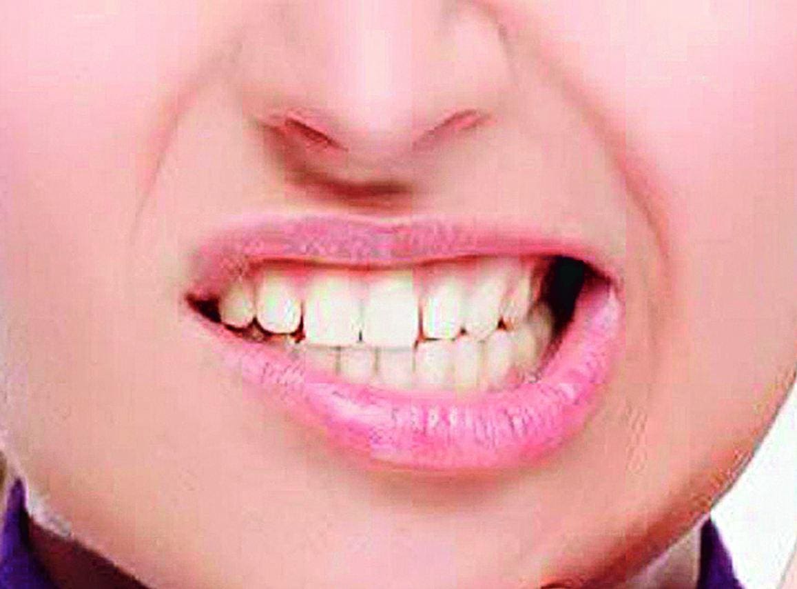 Crises O bruxismo provoca ranger de dentes e contração da mandíbula