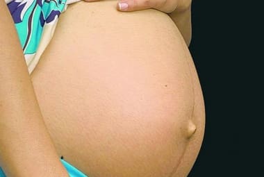 Mães em união homoafetiva conseguem licença-maternidade estendida, mas benefício ainda é restrito