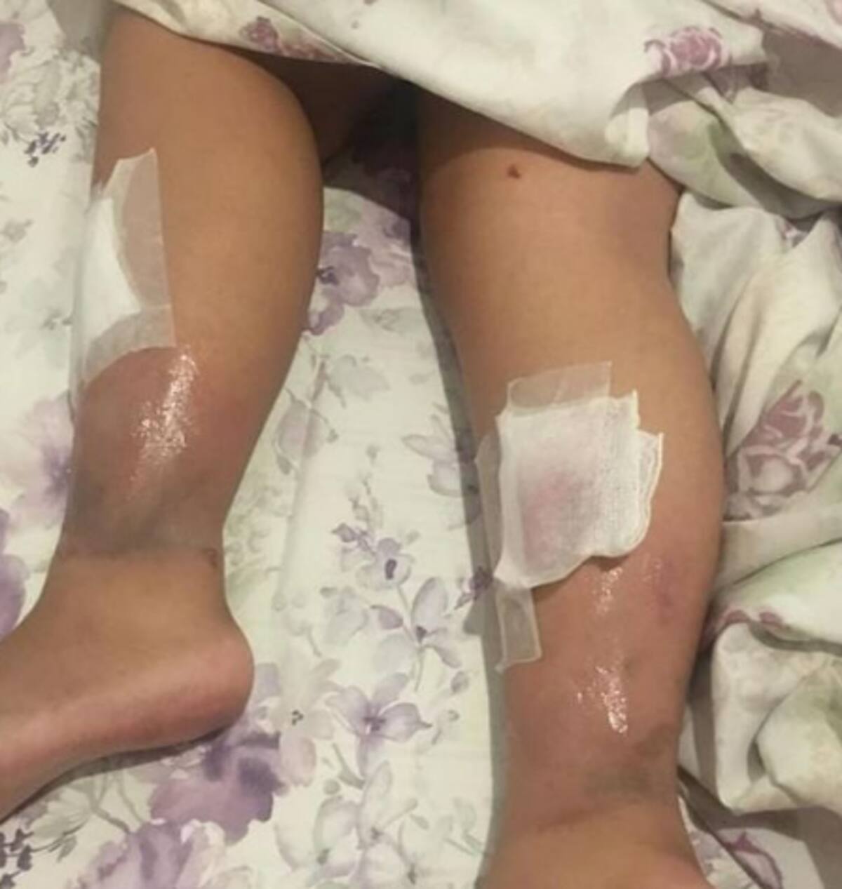 Fotos dos ferimentos foram publicadas nas redes sociais