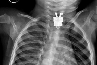 Criança engole pingente de Bob Esponja e aparece em raio X