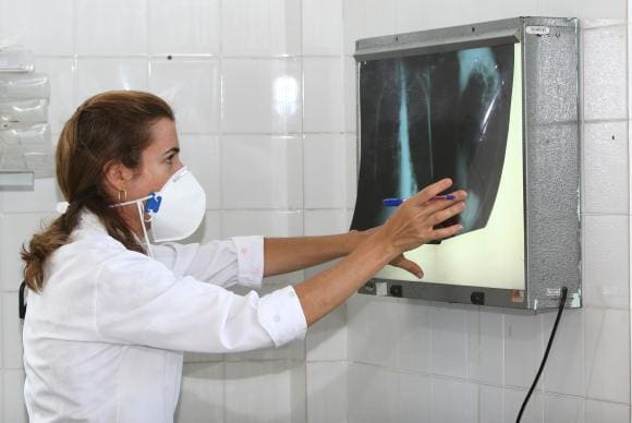 tuberculose 