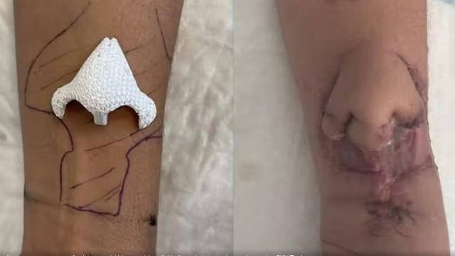 Médicos criaram um nariz no próprio corpo da paciente na França