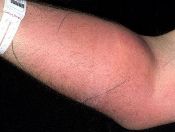 Homem injetava sêmen no braço
