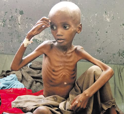 Criança gravemente desnutrida em hospital de Banadir, na Somália