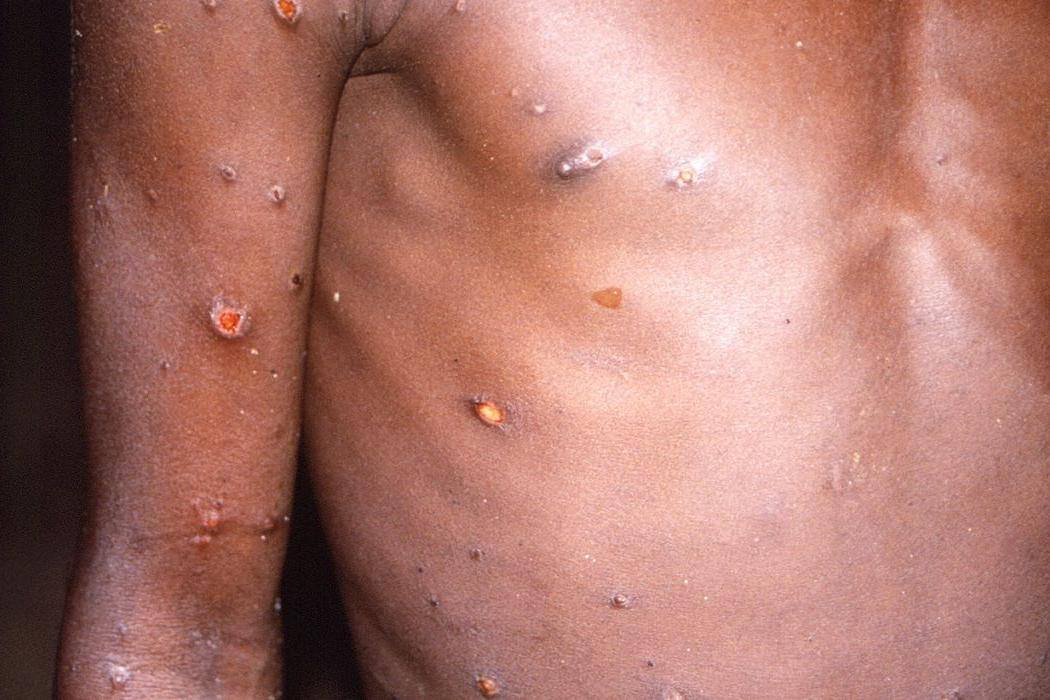 Infectados por varíola dos macacos ficam com corpo cheio de feridas
